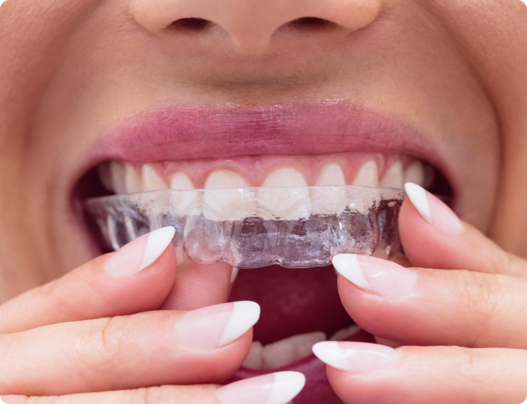 etica-dental-especialidades-ortodoncia-invisalign-salud-bucal-desktop